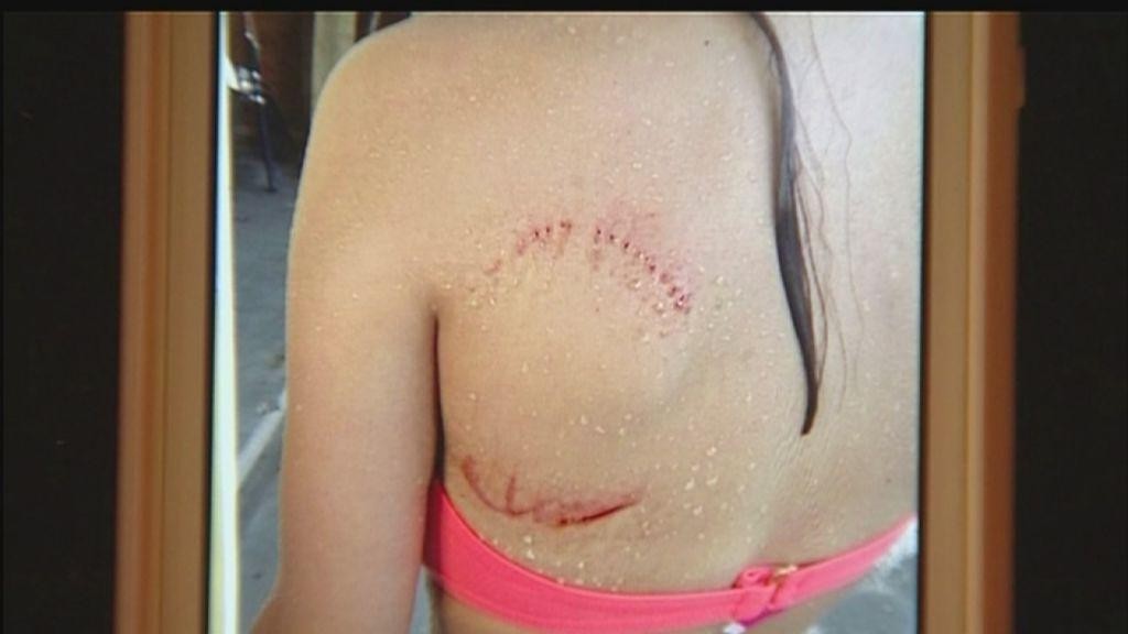 Shark Bite